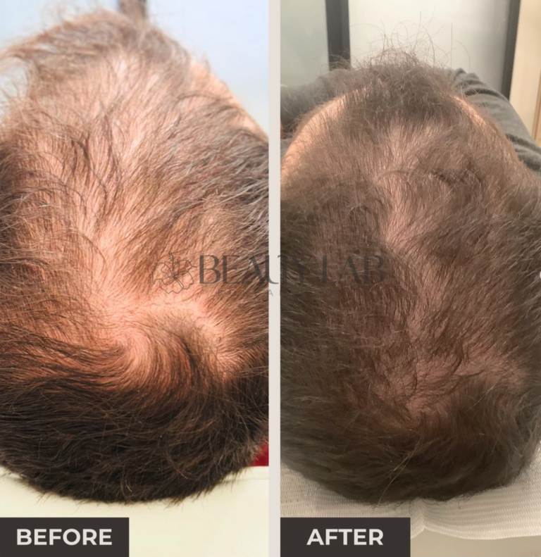 male patient showing before and after result after a hair restoration treatment